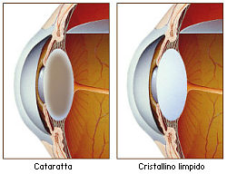 cataratta