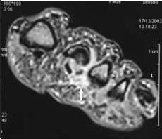 neuroma di morton procedura ecoguidata